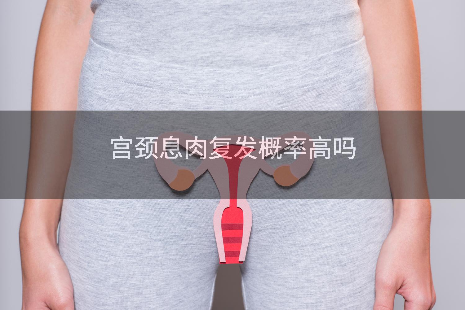 宫颈息肉复发概率高吗