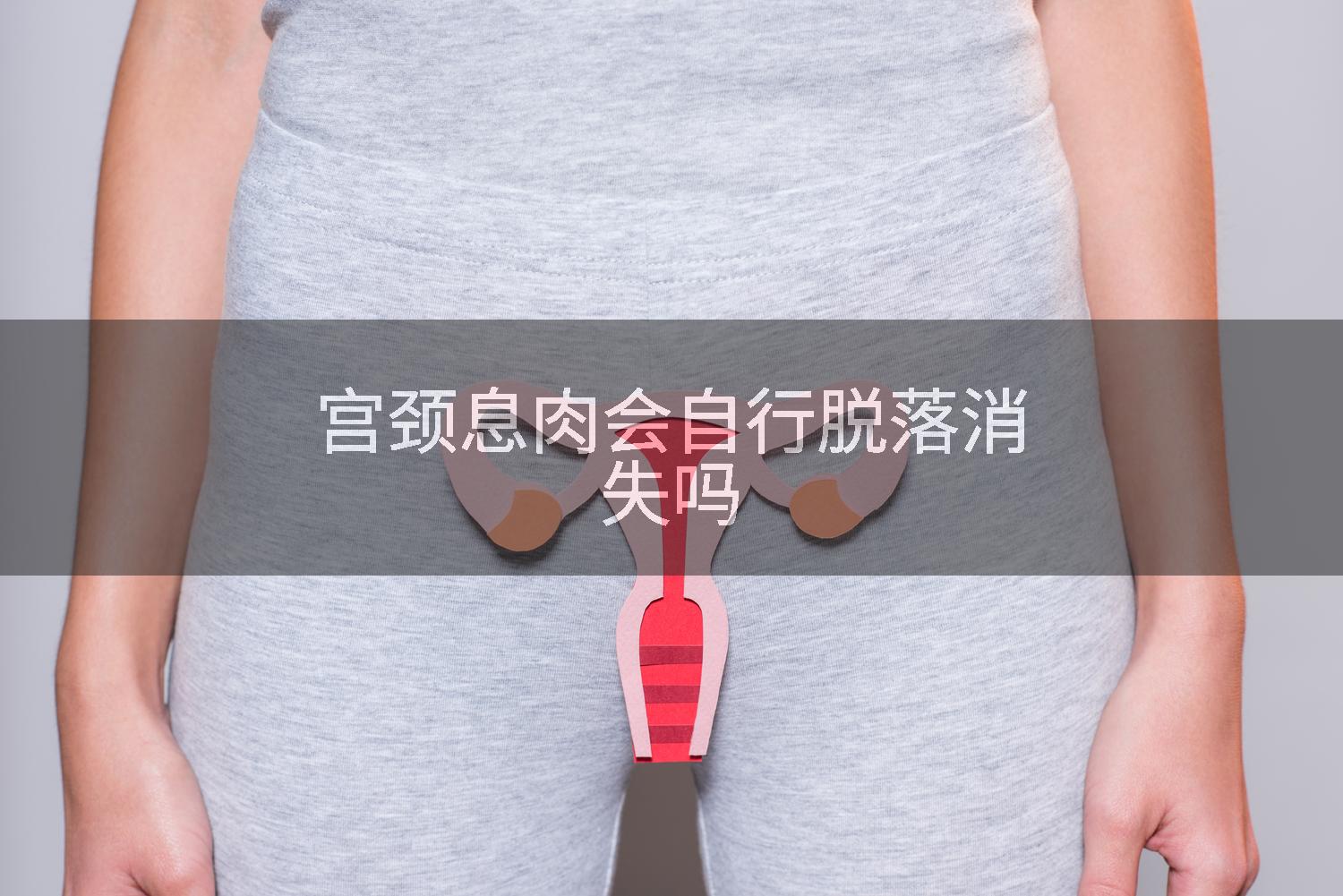 宫颈息肉会自行脱落消失吗