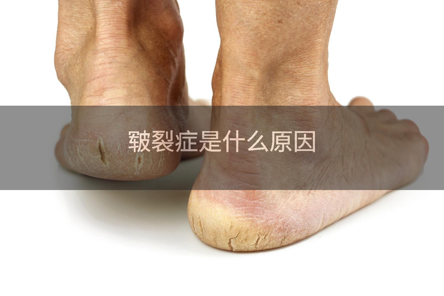 皲裂症是什么原因