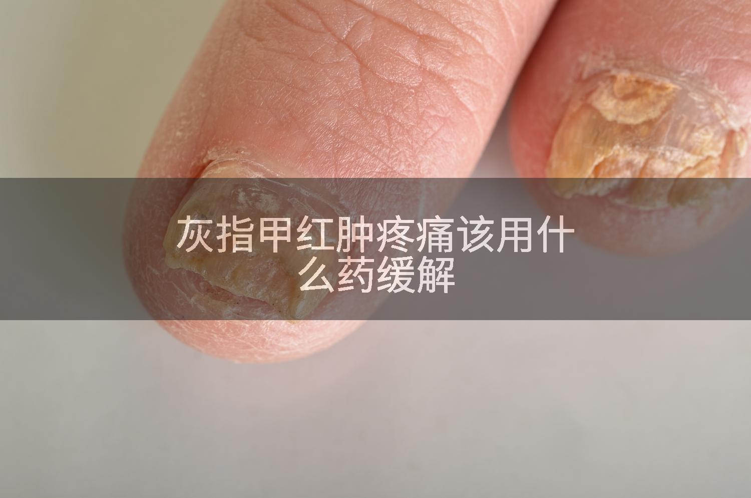 灰指甲红肿疼痛该用什么药缓解