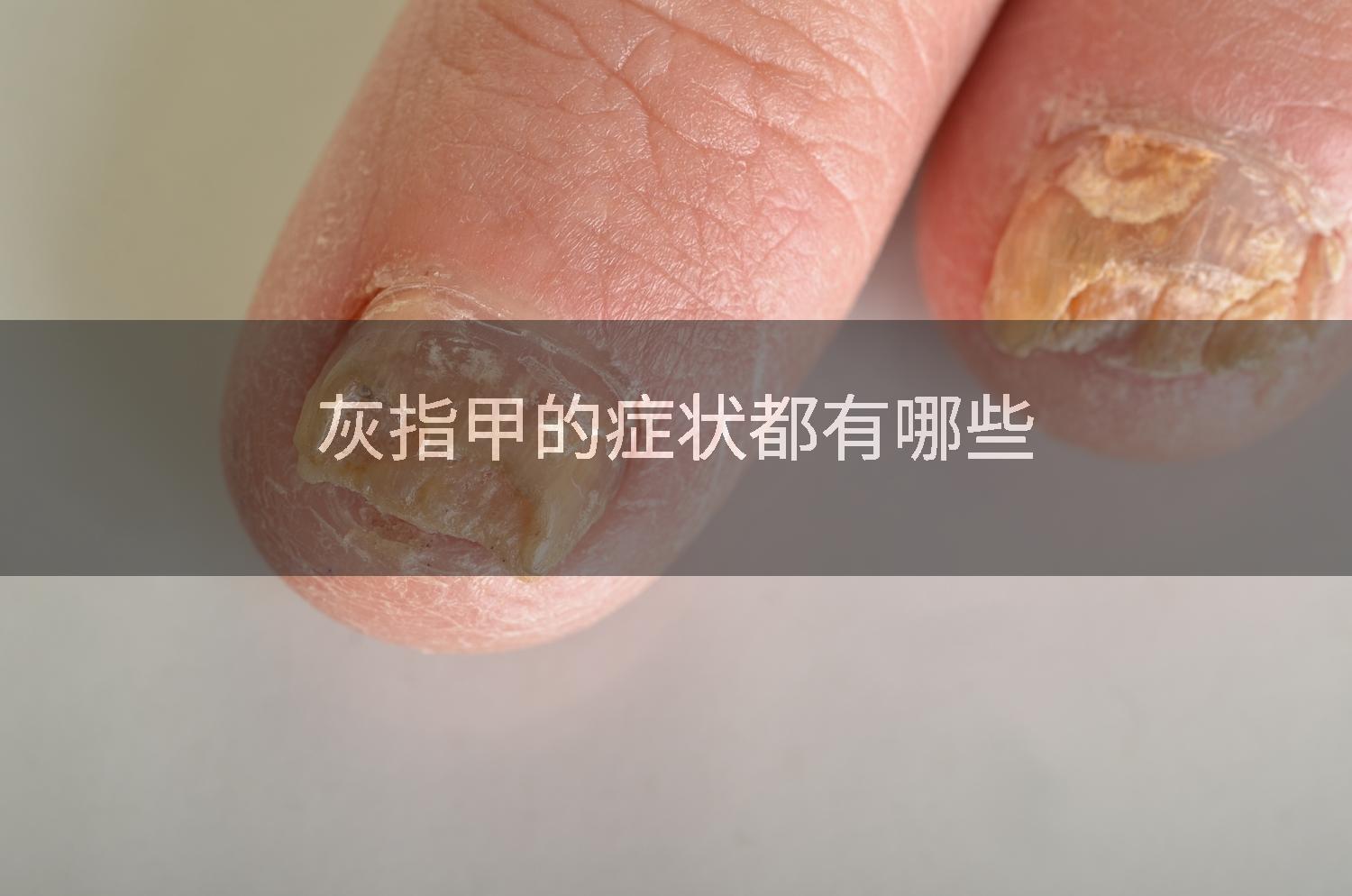 灰指甲的症状都有哪些