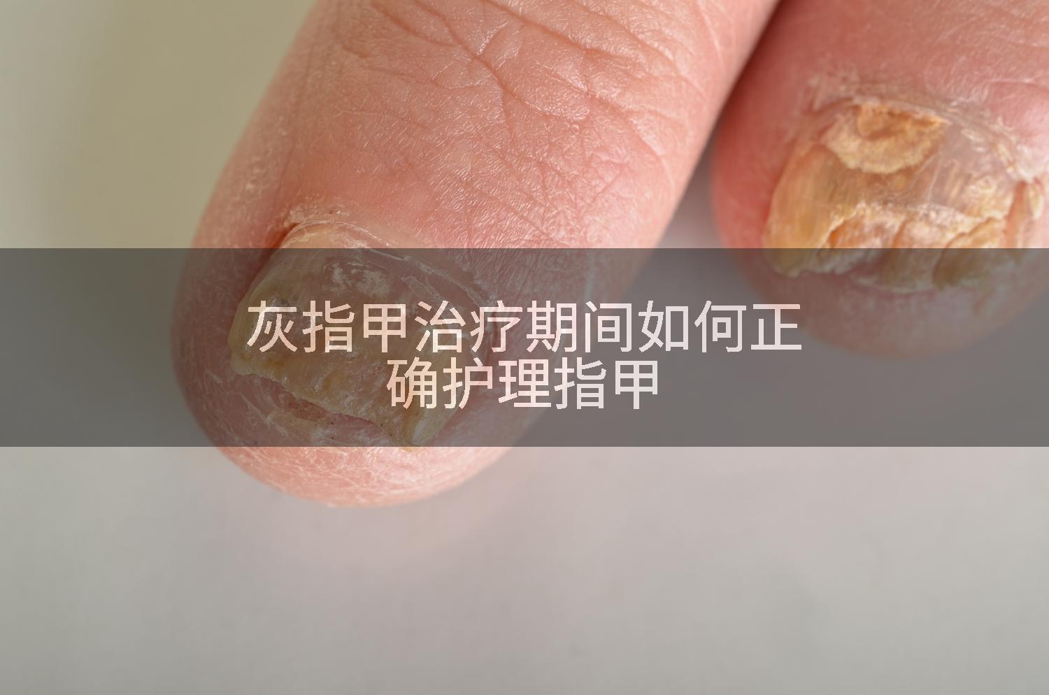 灰指甲治疗期间如何正确护理指甲