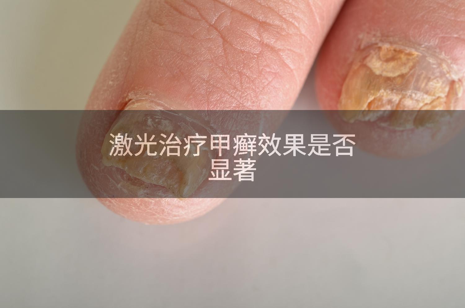 激光治疗甲癣效果是否显著