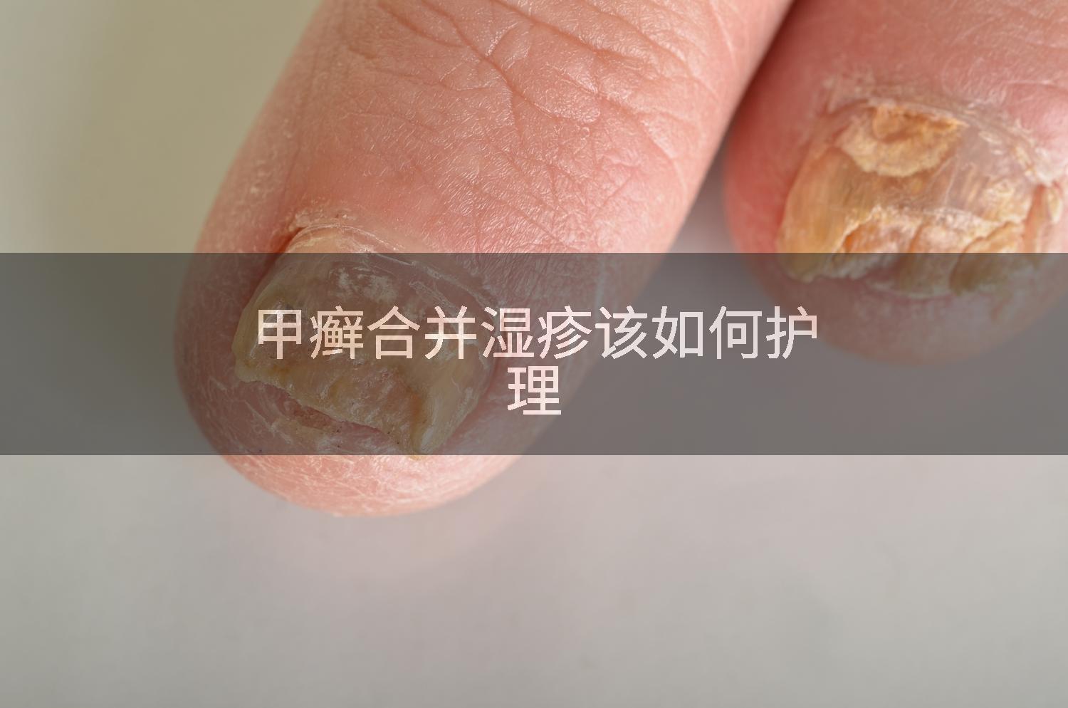 甲癣合并湿疹该如何护理