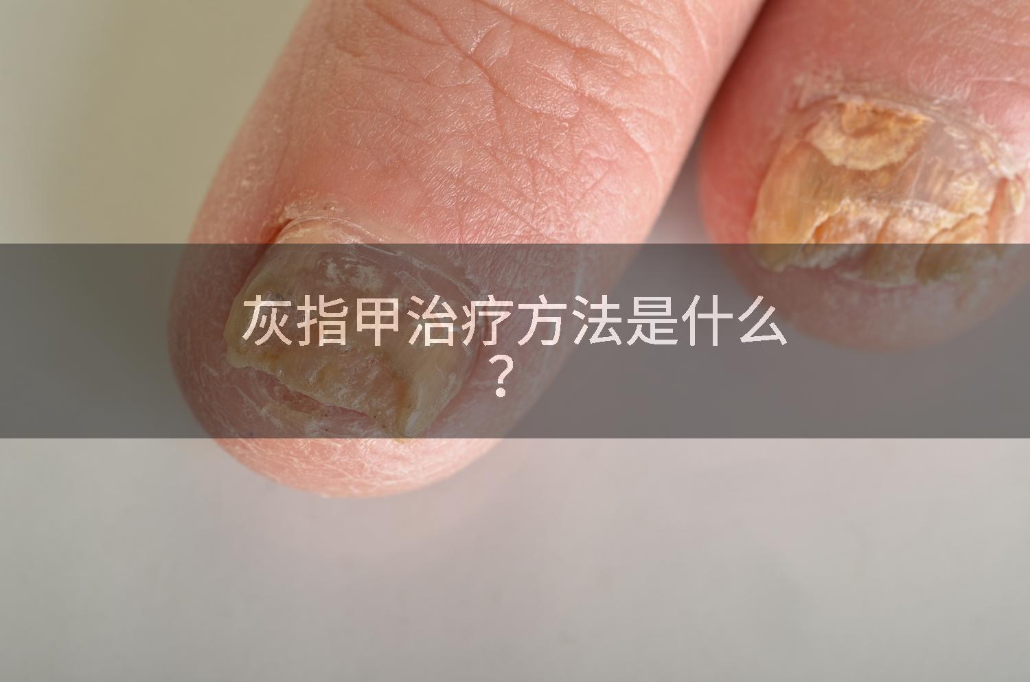 灰指甲治疗方法是什么？