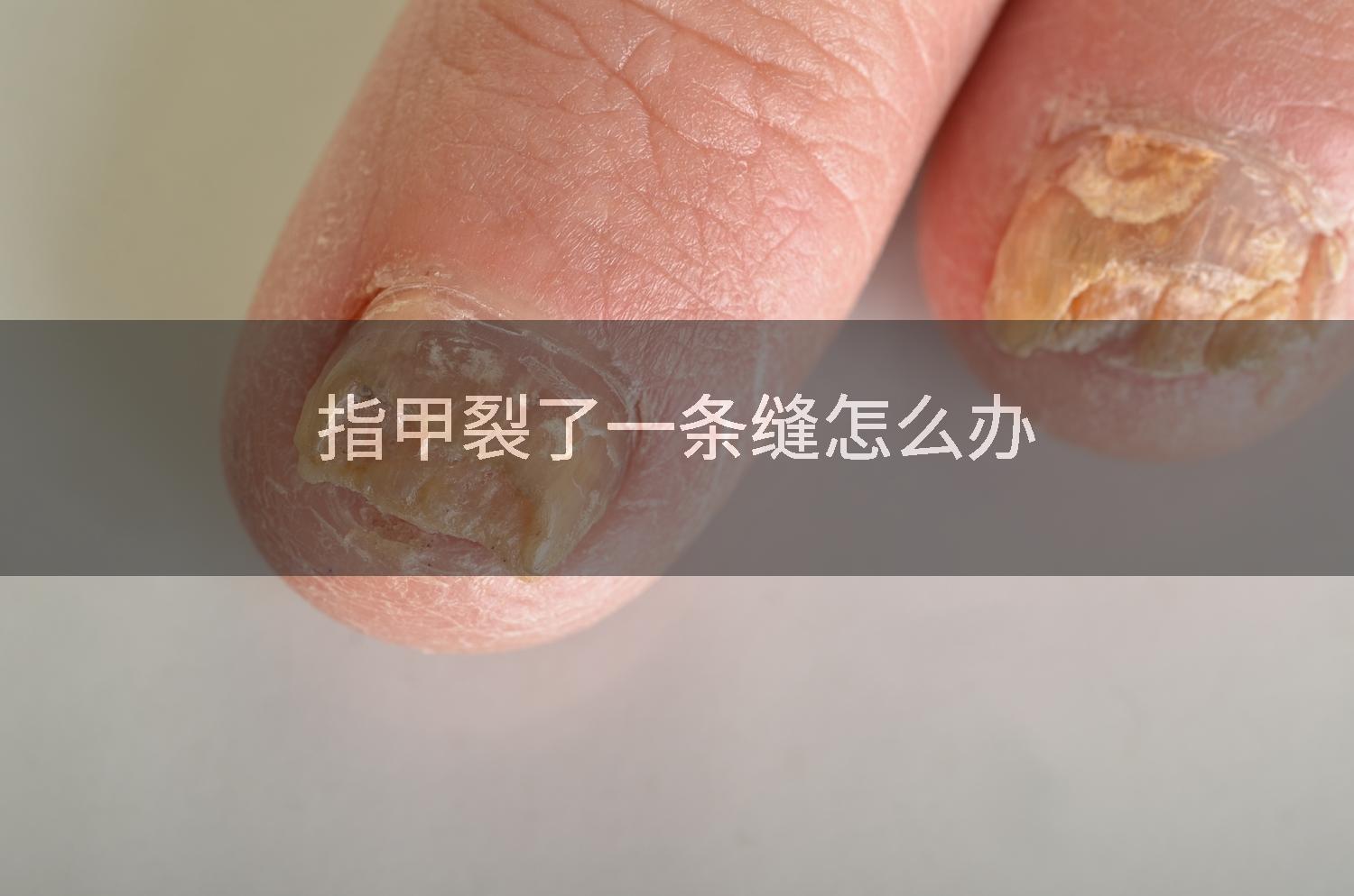 指甲裂了一条缝怎么办