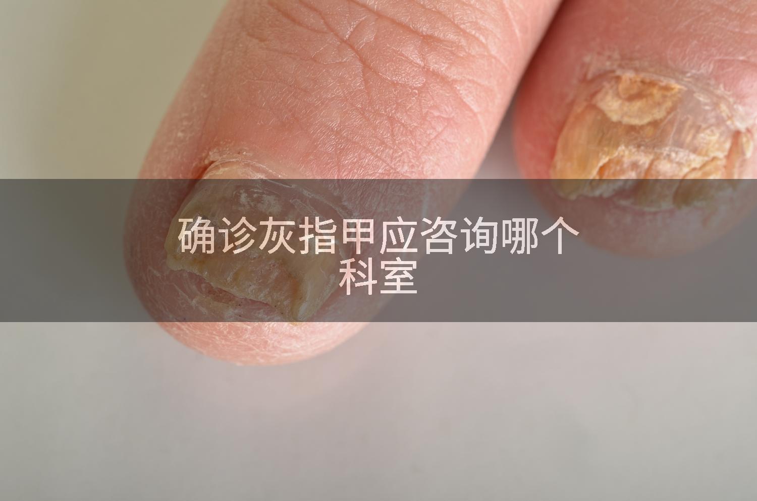 确诊灰指甲应咨询哪个科室