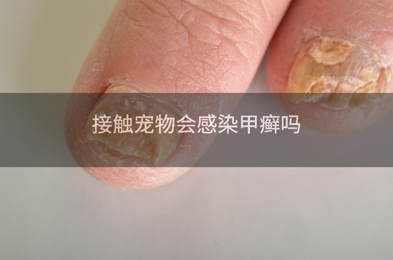 接触宠物会感染甲癣吗