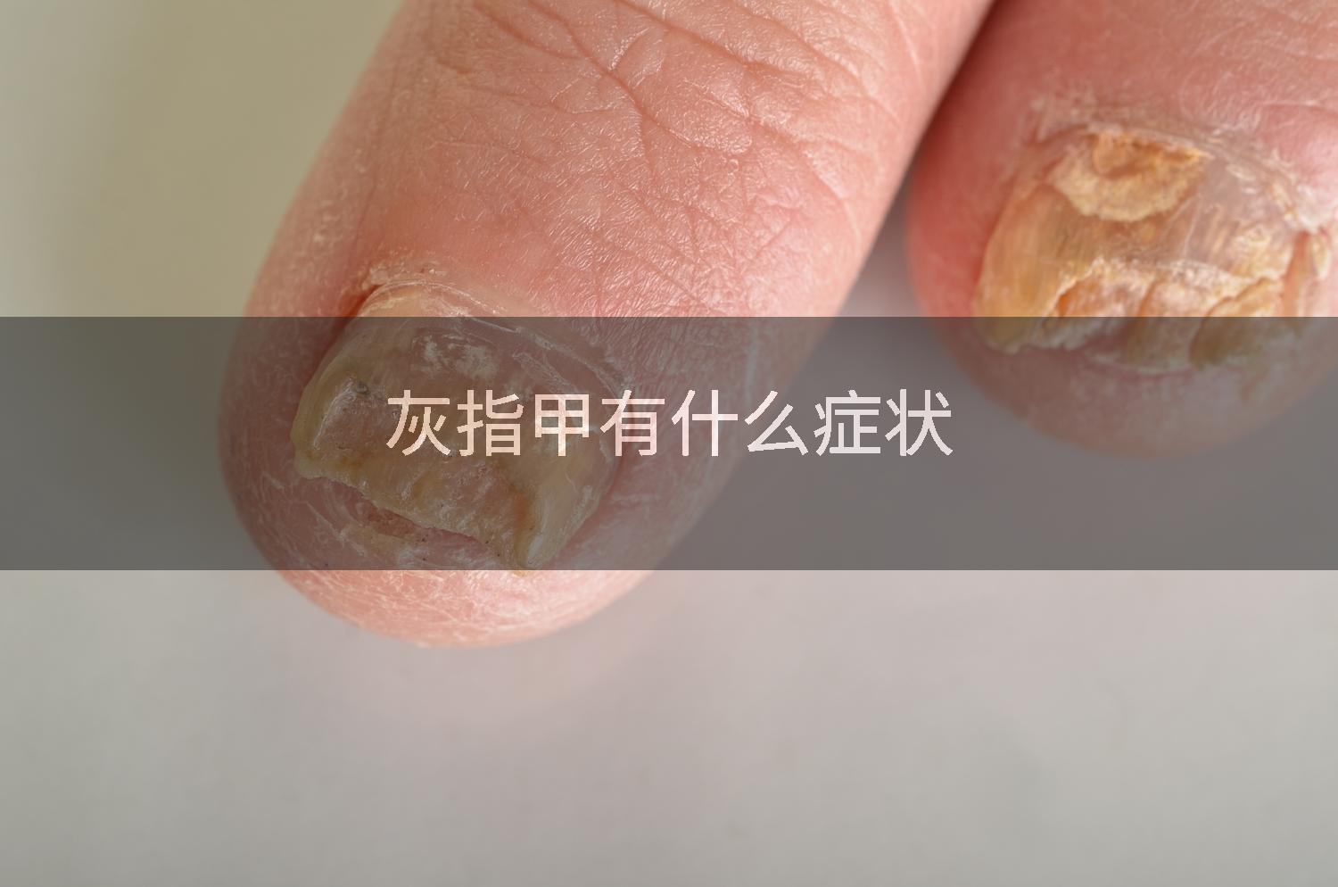 灰指甲有什么症状