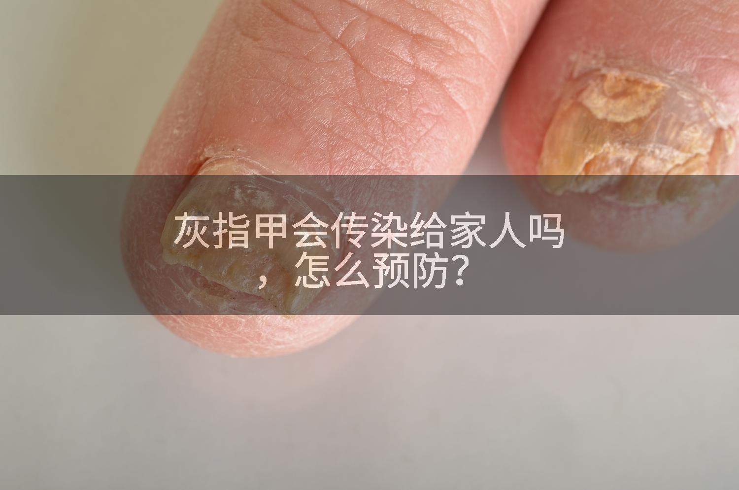 灰指甲会传染给家人吗，怎么预防？