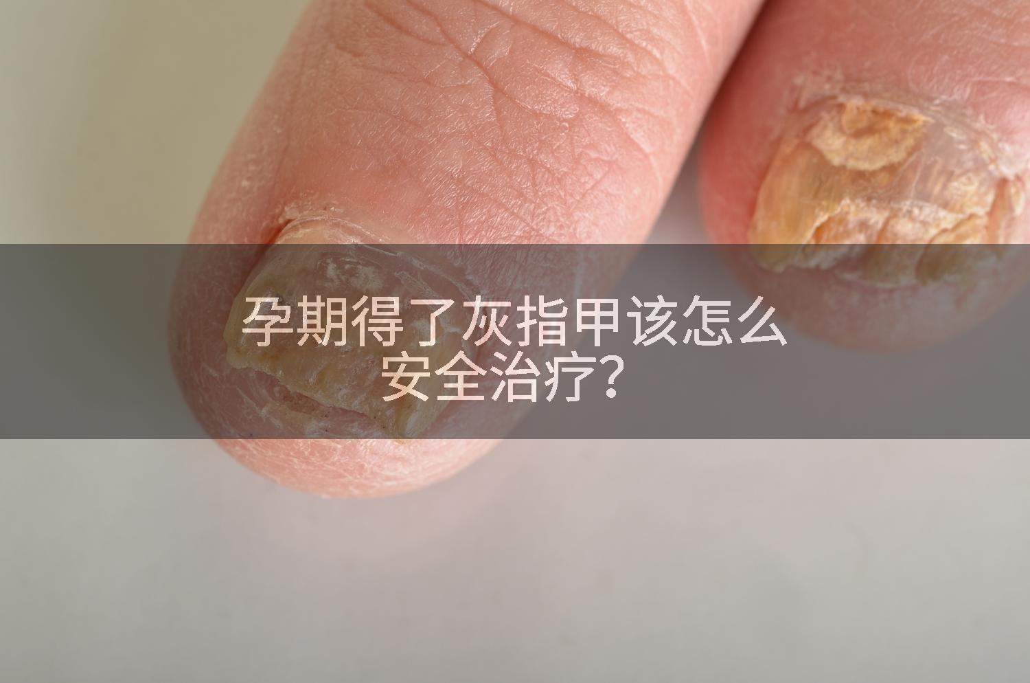 孕期得了灰指甲该怎么安全治疗？