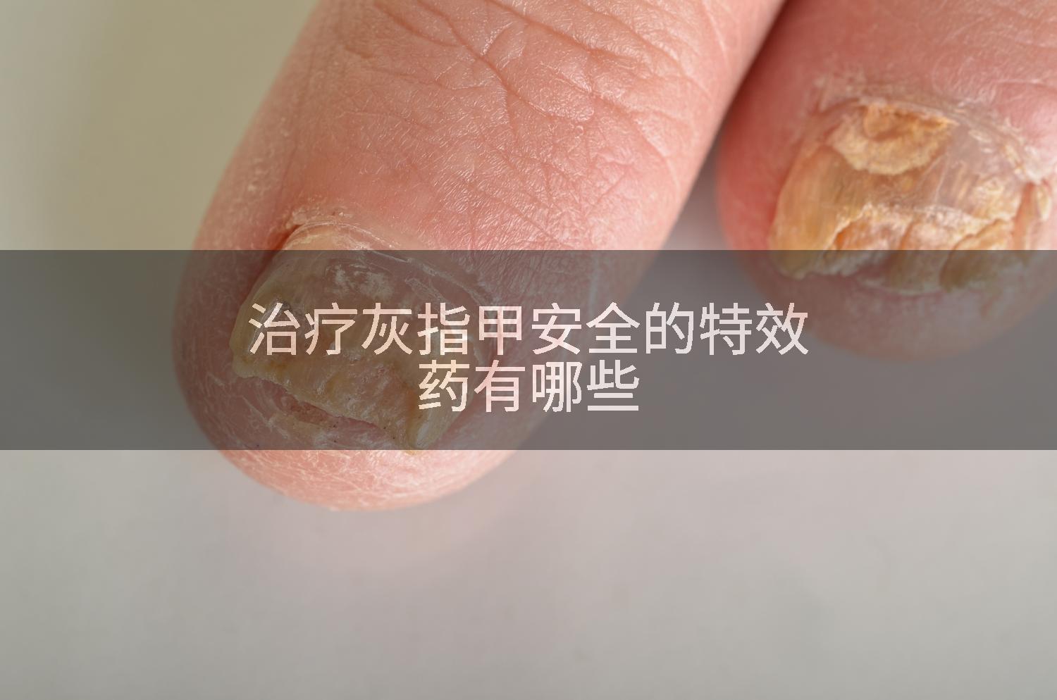 治疗灰指甲安全的特效药有哪些