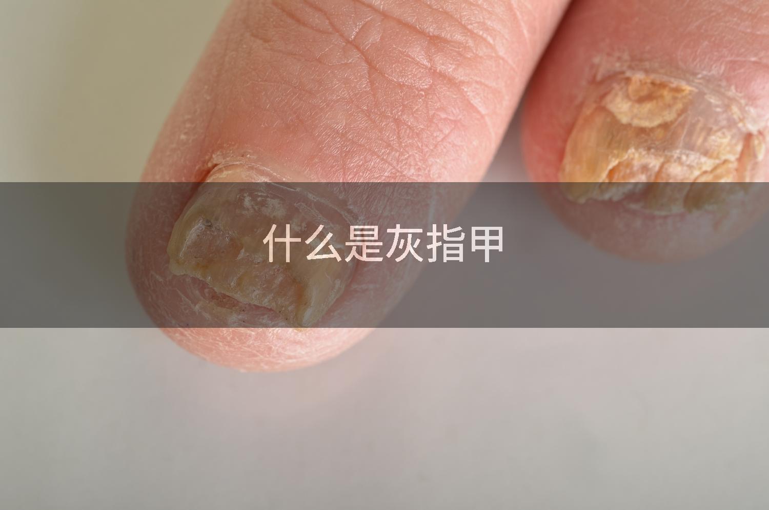 什么是灰指甲