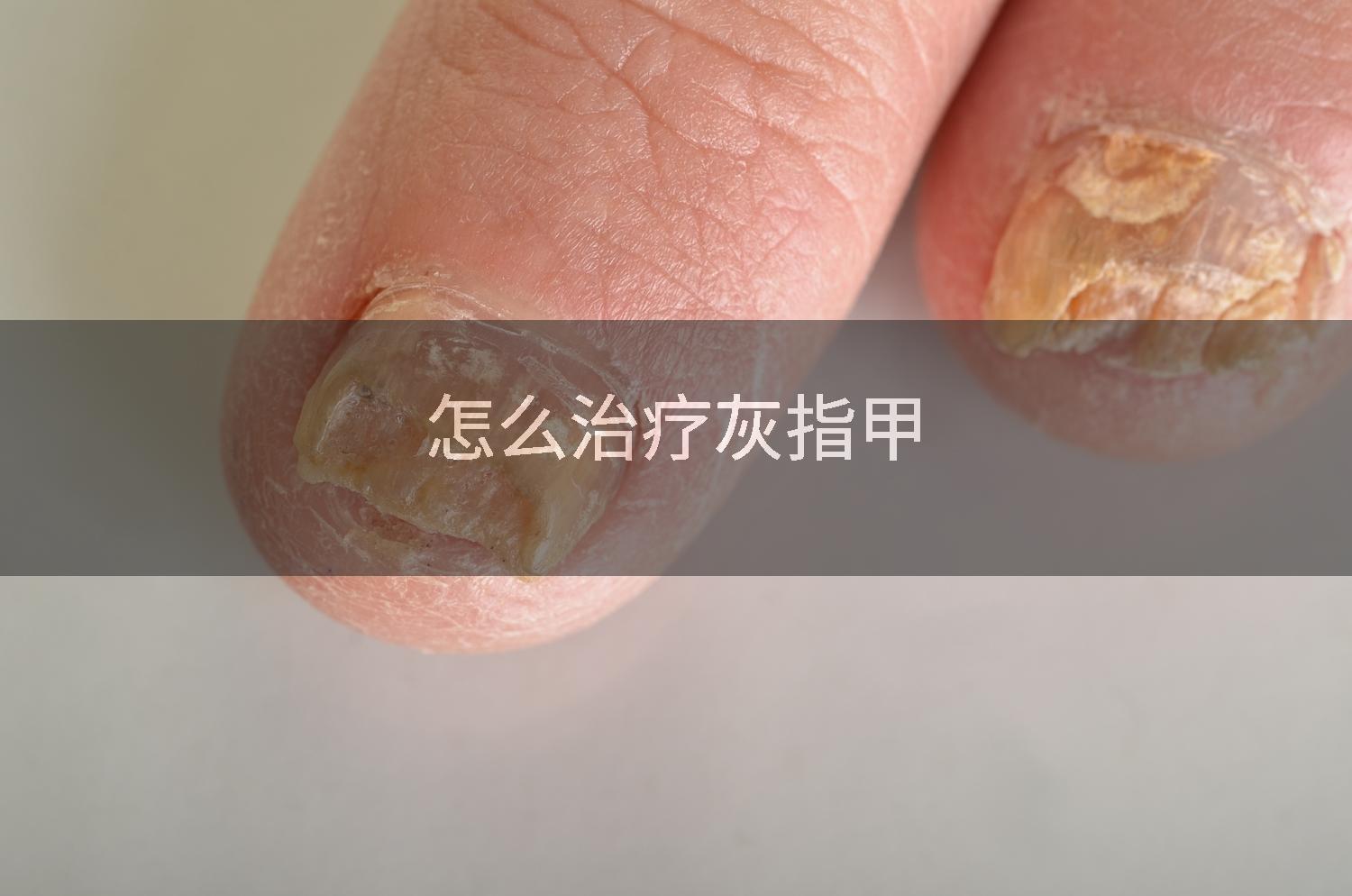 怎么治疗灰指甲