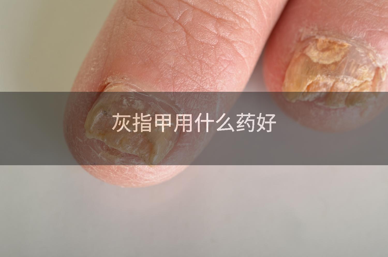 灰指甲用什么药好