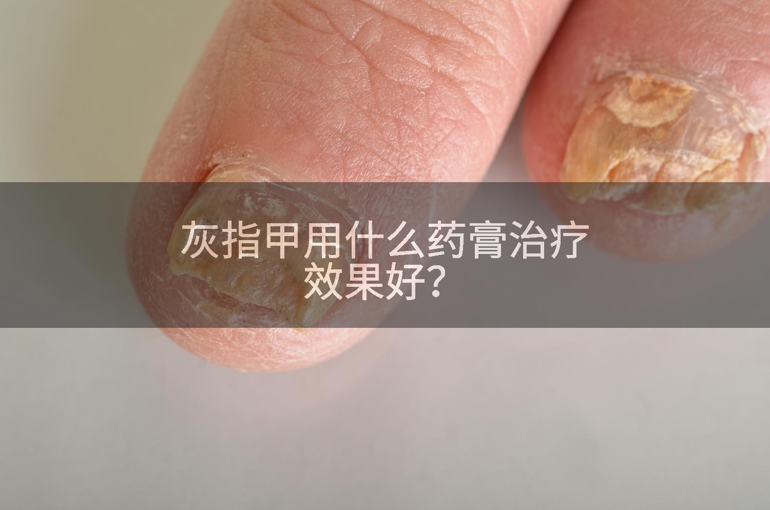 灰指甲用什么药膏治疗效果好？