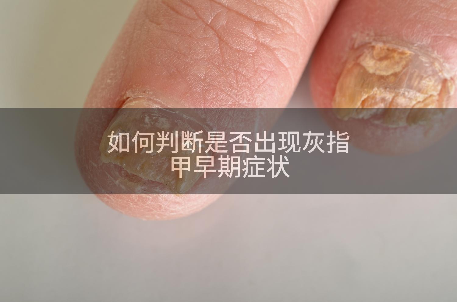 如何判断是否出现灰指甲早期症状