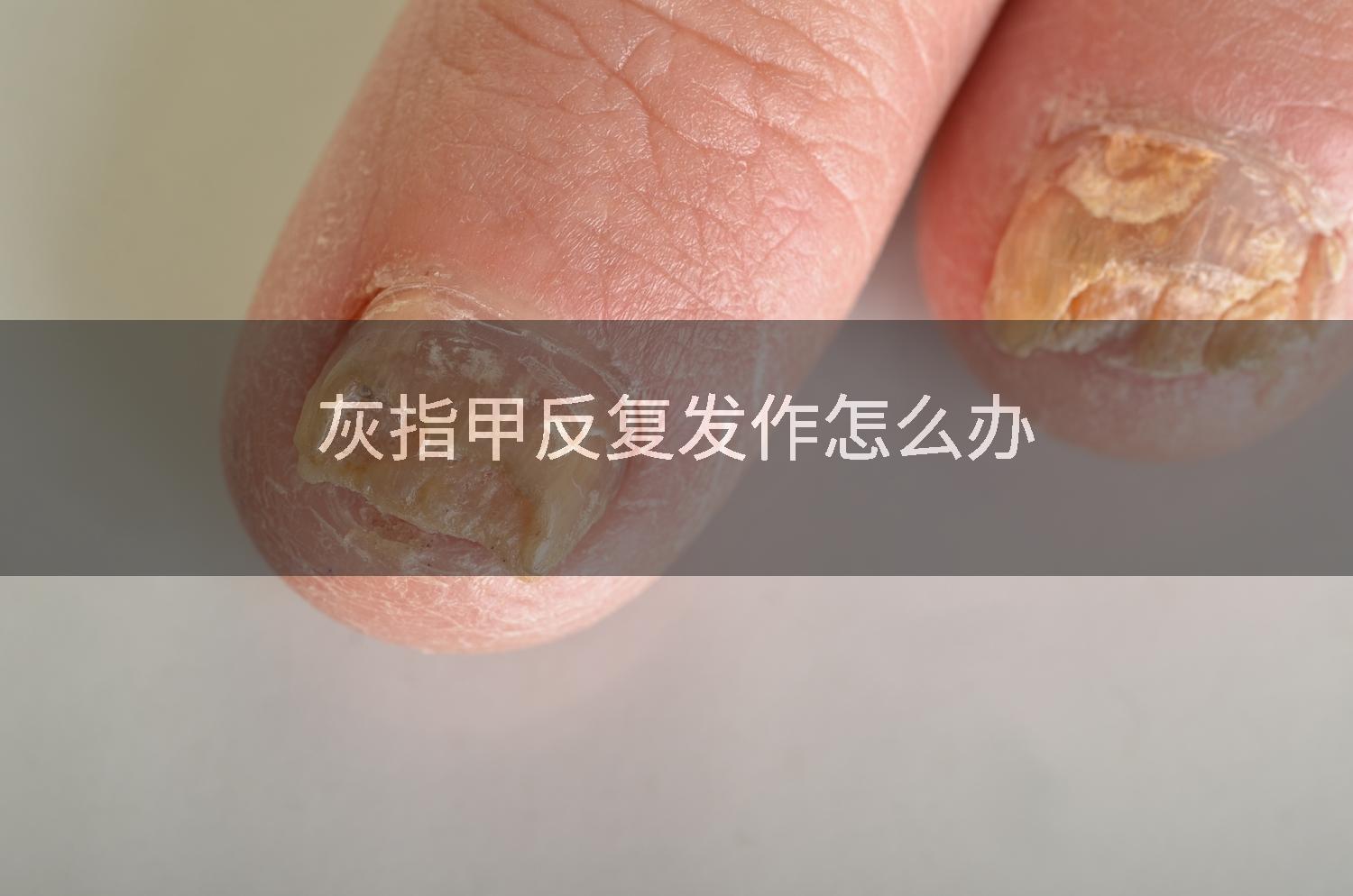 灰指甲反复发作怎么办