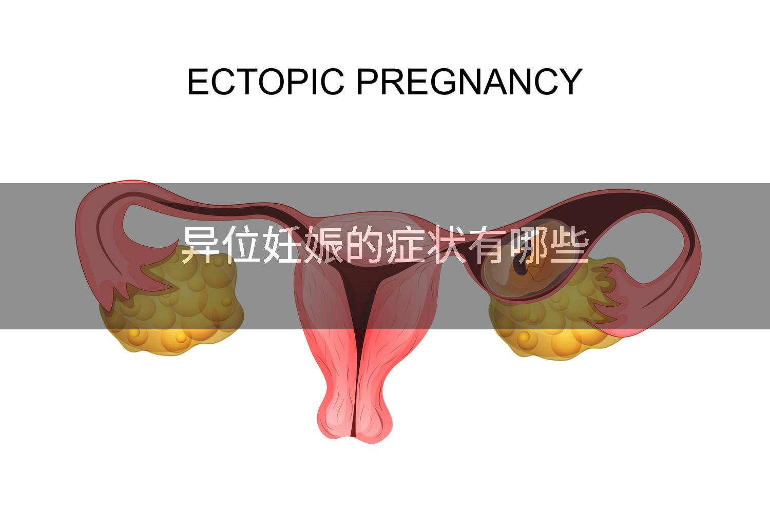 异位妊娠的症状有哪些
