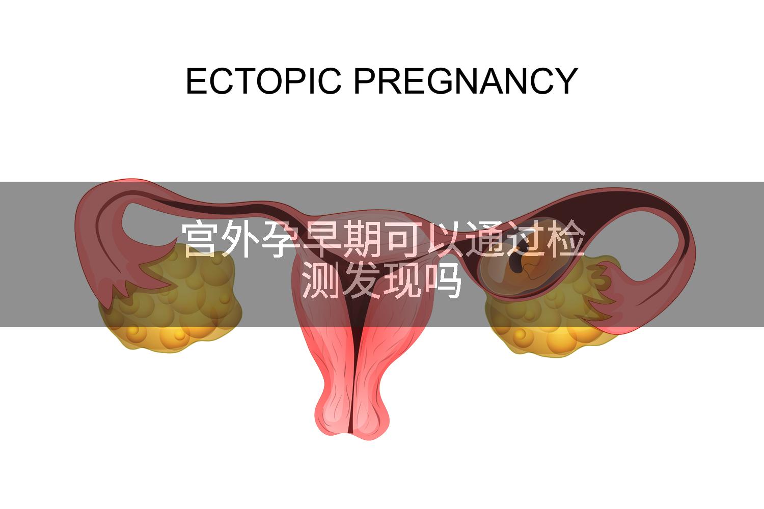 宫外孕早期可以通过检测发现吗