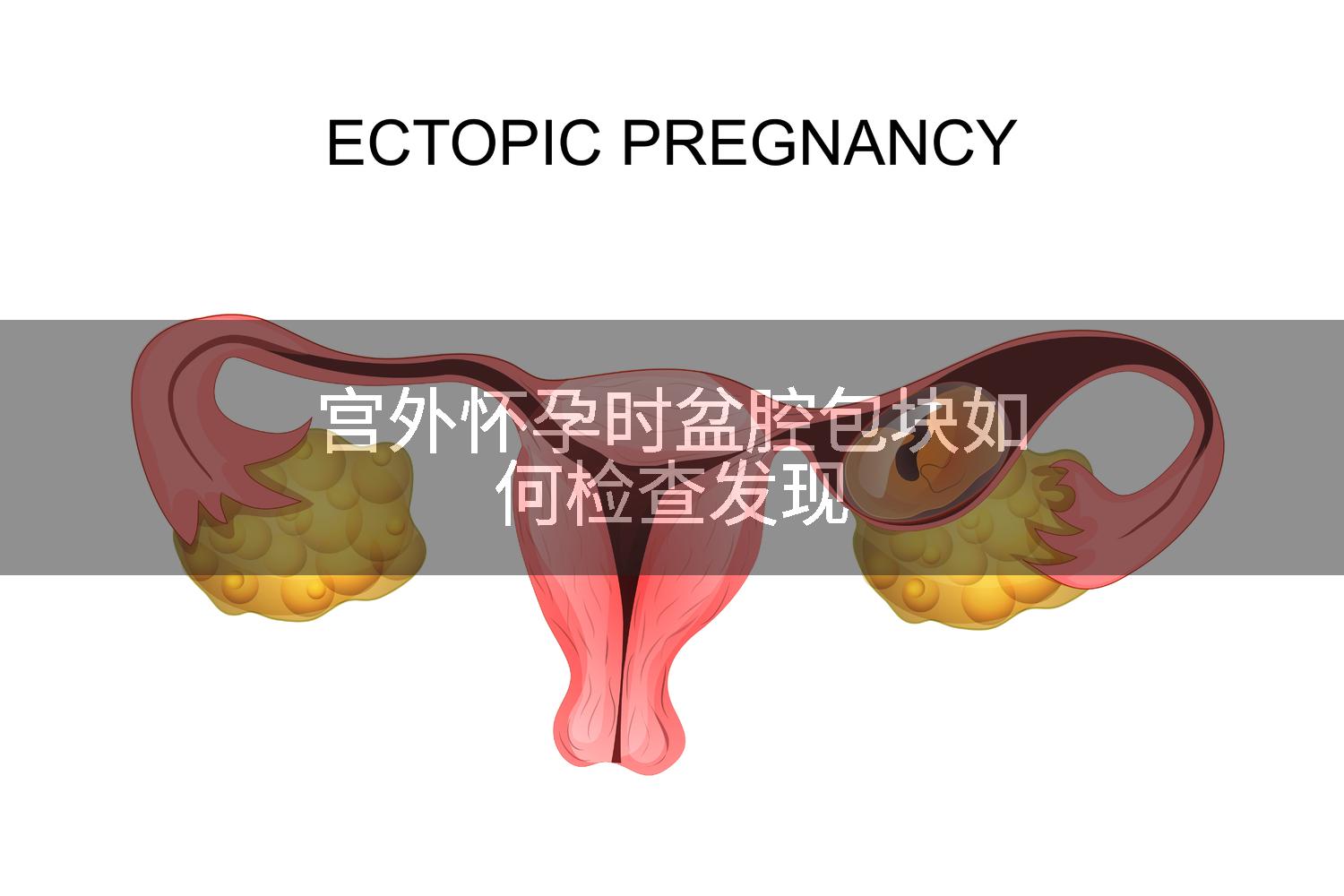 宫外怀孕时盆腔包块如何检查发现