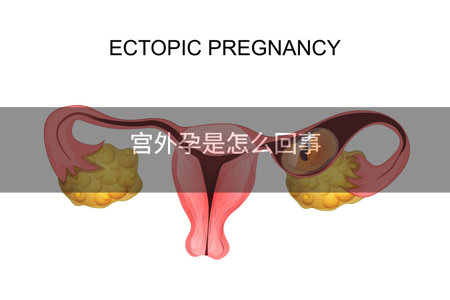 宫外孕是怎么回事