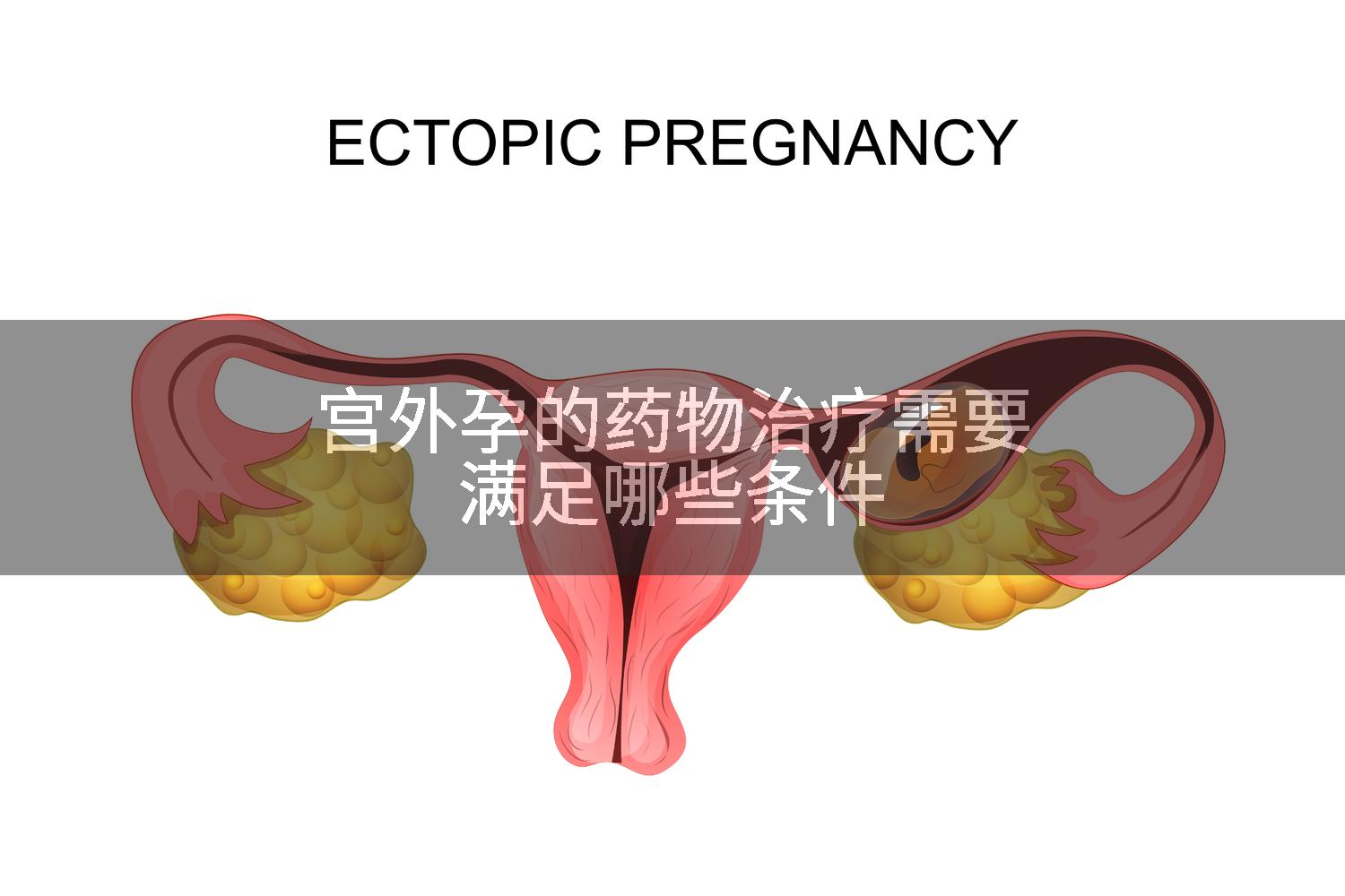 宫外孕的药物治疗需要满足哪些条件