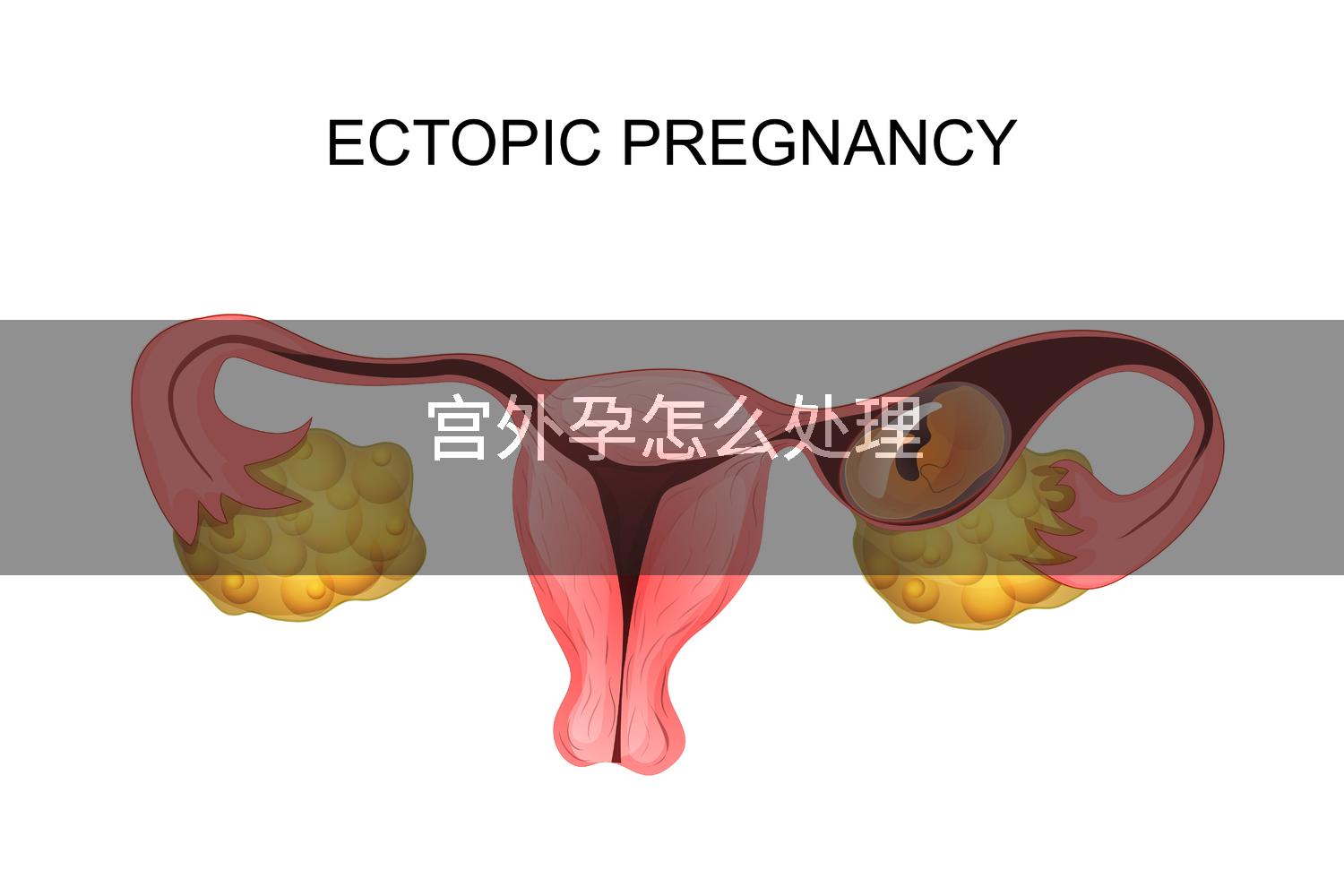 宫外孕怎么处理