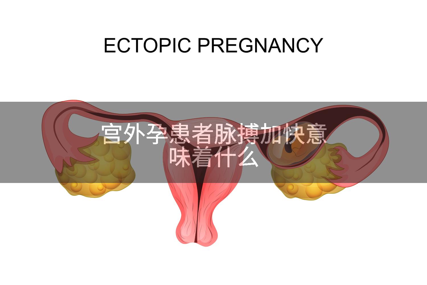 宫外孕患者脉搏加快意味着什么