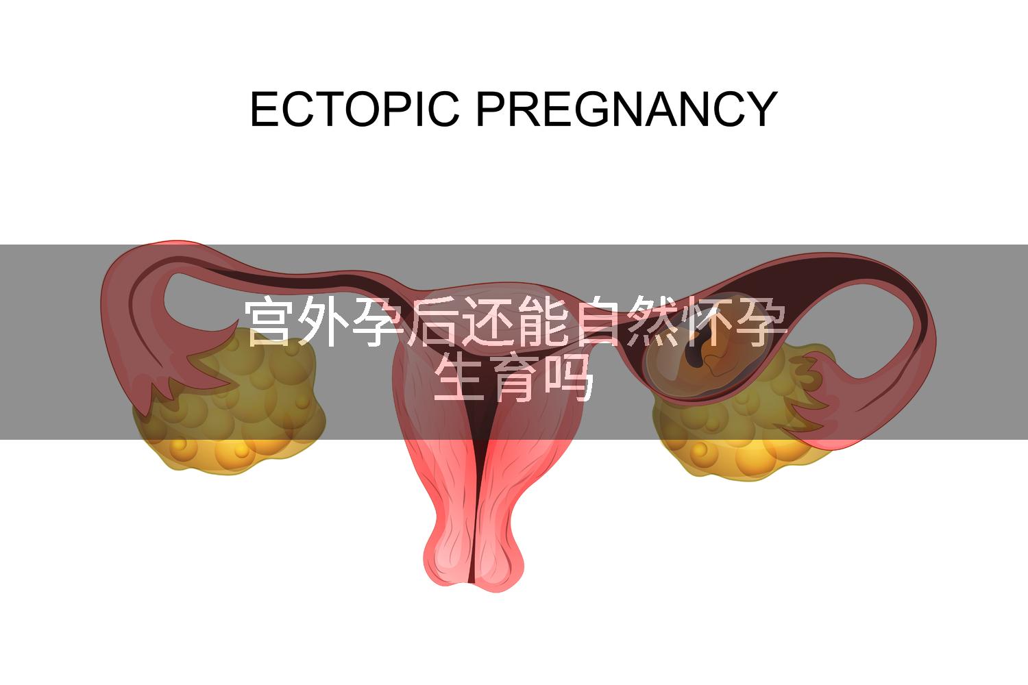 宫外孕后还能自然怀孕生育吗