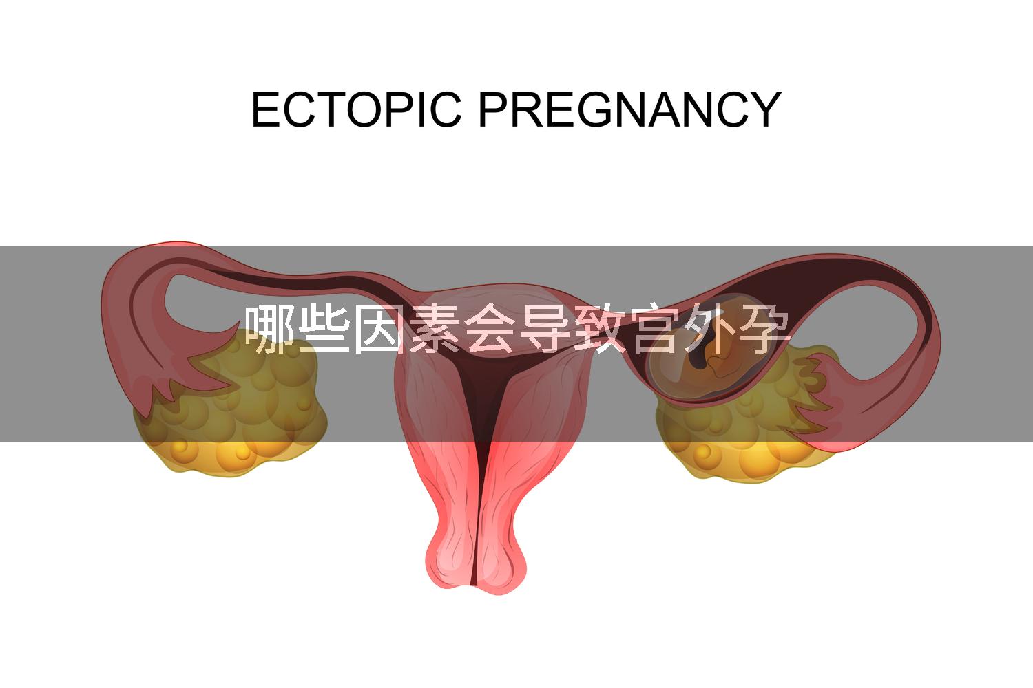 哪些因素会导致宫外孕