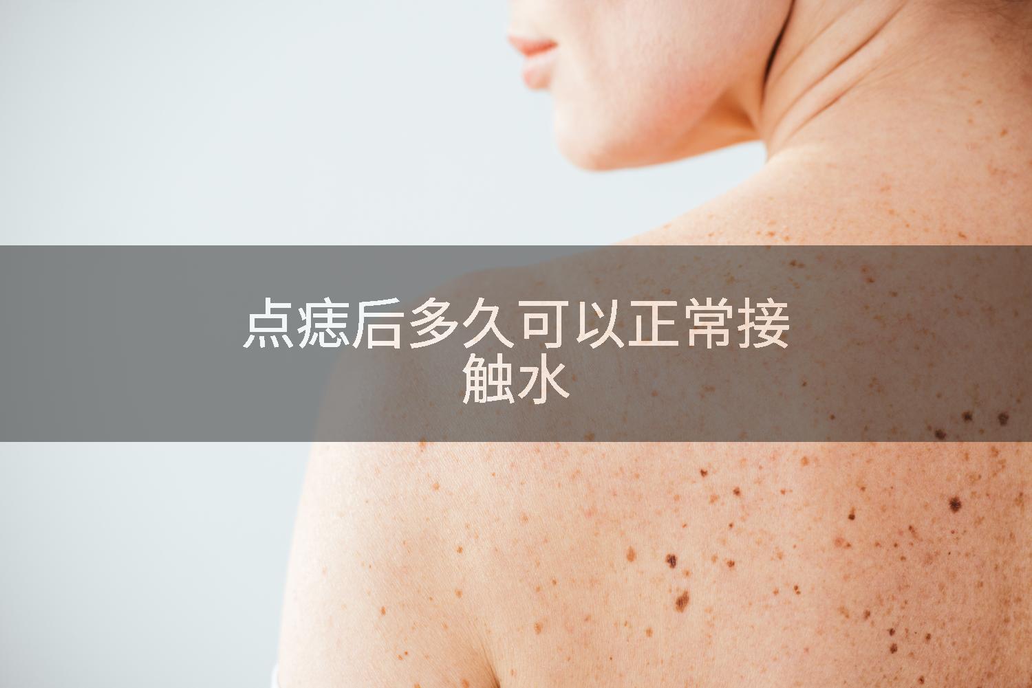 点痣后多久可以正常接触水