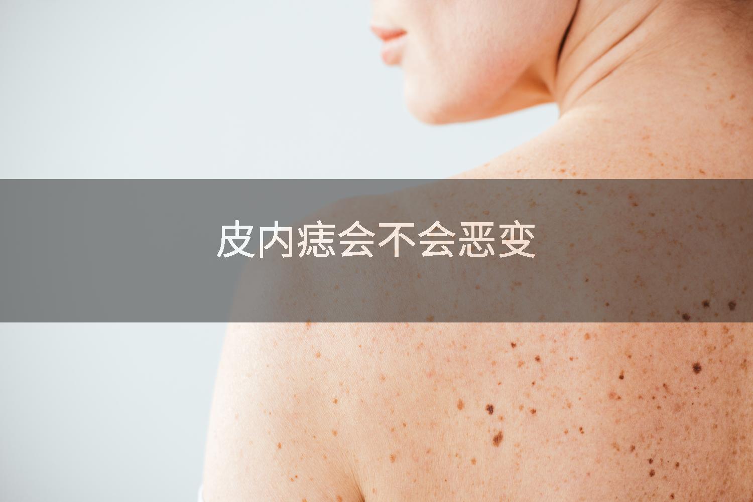 皮内痣会不会恶变