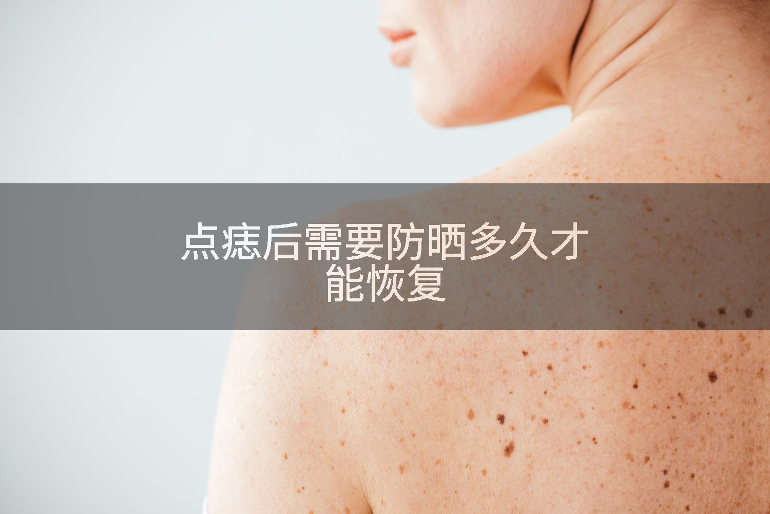 点痣后需要防晒多久才能恢复