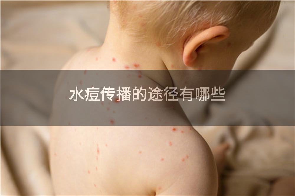 水痘传播的途径有哪些