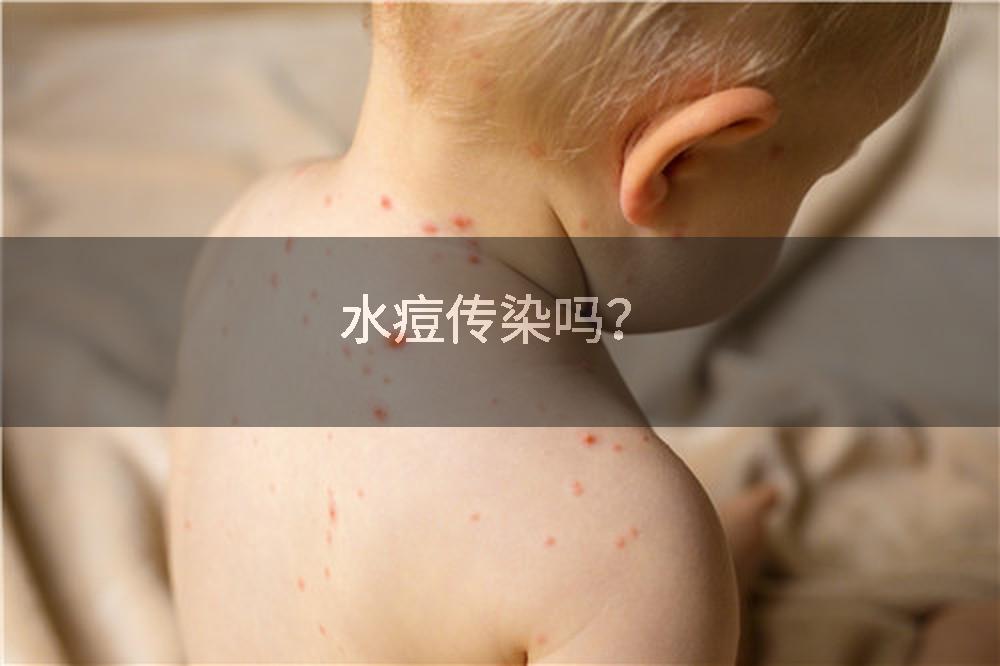 水痘传染吗？