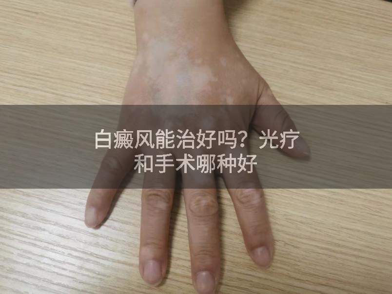 白癜风能治好吗？光疗和手术哪种好