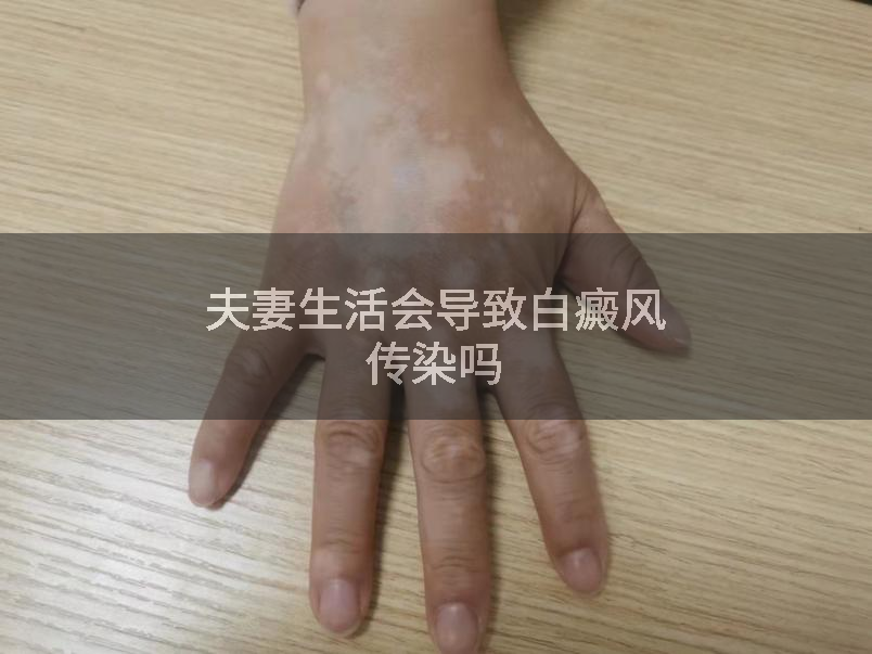 夫妻生活会导致白癜风传染吗