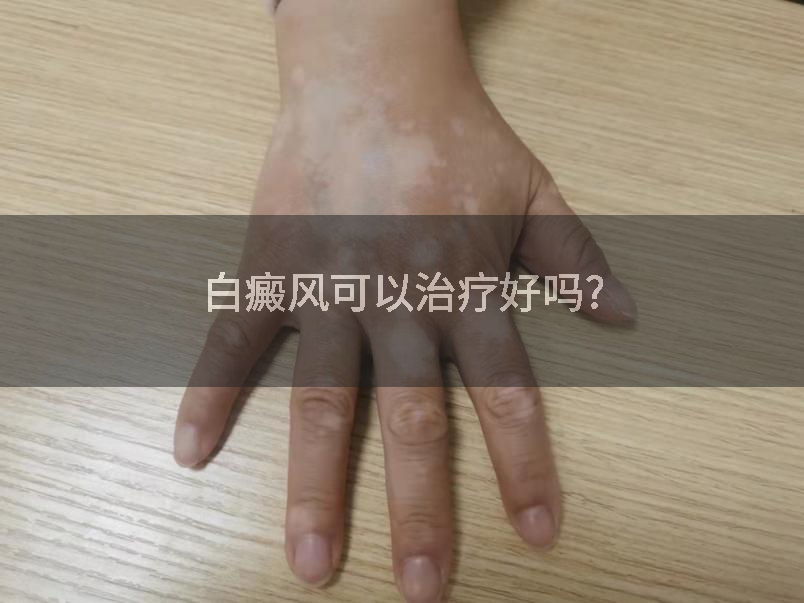 白癜风可以治疗好吗?