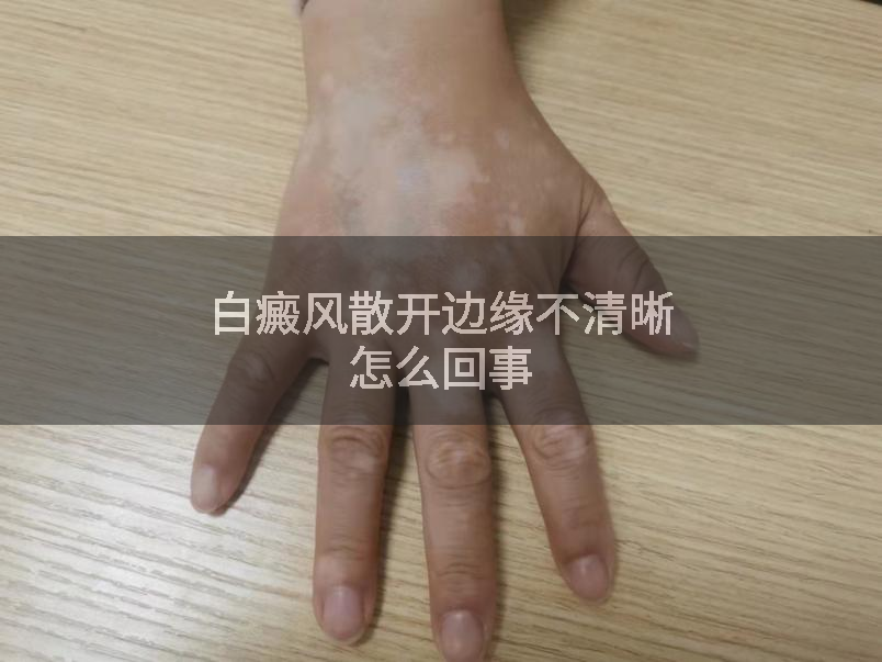 白癜风散开边缘不清晰怎么回事