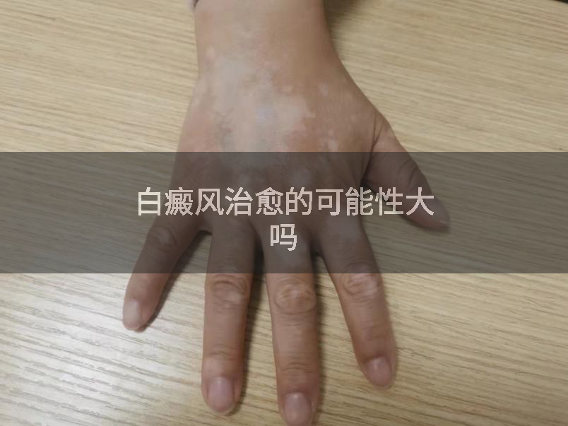 白癜风治愈的可能性大吗