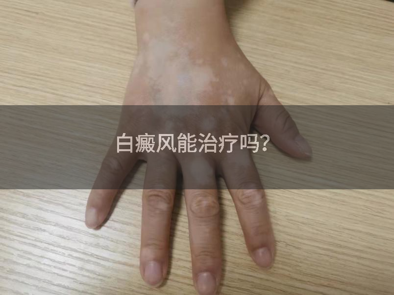 白癜风能治疗吗？