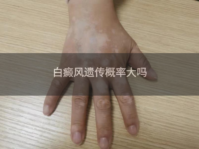白癜风遗传概率大吗