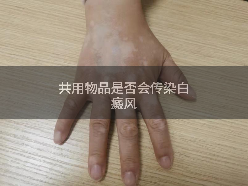 共用物品是否会传染白癜风