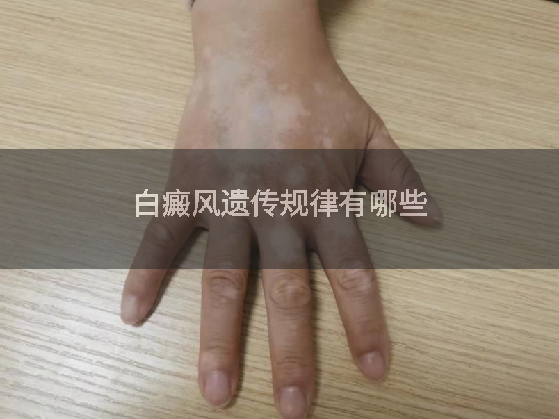 白癜风遗传规律有哪些