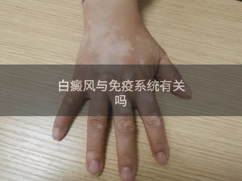 白癜风与免疫系统有关吗