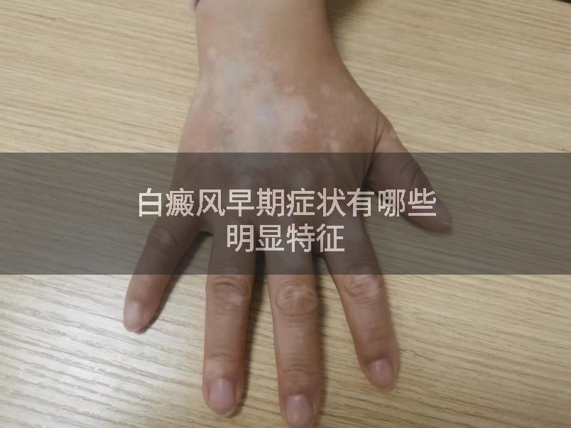 白癜风早期症状有哪些明显特征