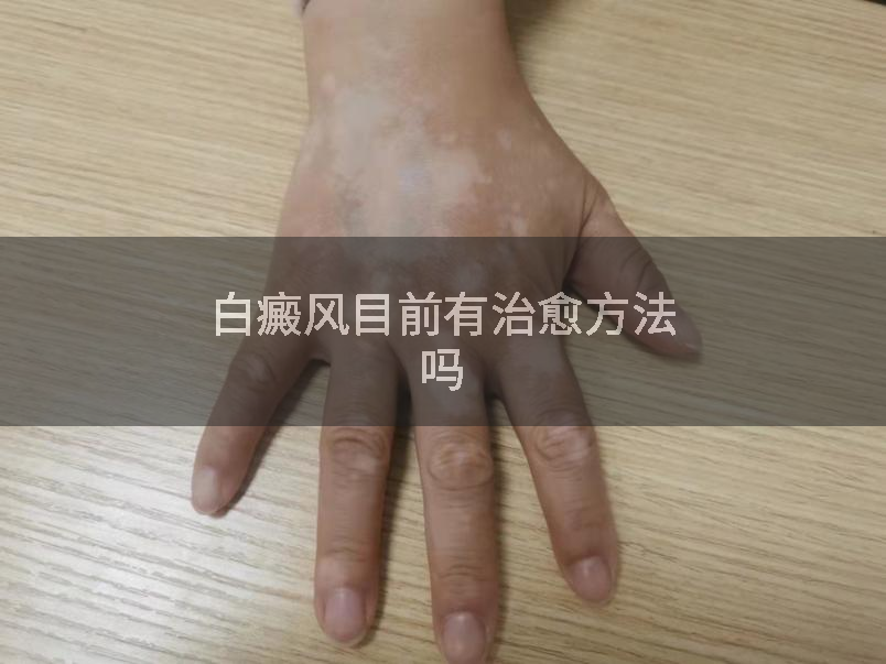 白癜风目前有治愈方法吗