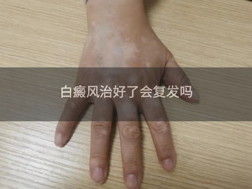 白癜风治好了会复发吗