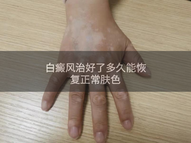 白癜风治好了多久能恢复正常肤色